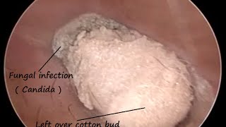 Removal of left over cotton bud  Q Tip   It causes Fungal infection with minute perforations [upl. by Linder]