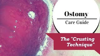 The Ostomy Crusting Technique Explained [upl. by Ardme946]