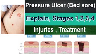 Pressure ulcer Bed sores  pressure ulcer stages 1 2 3 4  Injuries Prevention Assessment [upl. by Chaworth]