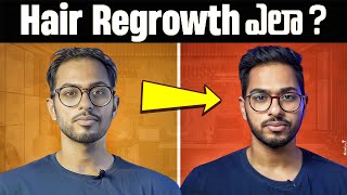 How I got my HAIR back  FULL GUIDE on Minoxidil Telugu [upl. by Aihsemaj913]