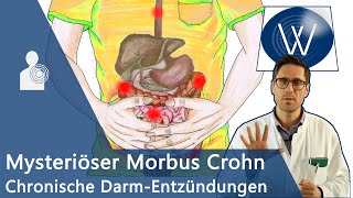 Morbus Crohn Ursache für unblutigen Durchfall amp Bauchschmerz Chronischentzündliche Darmerkrankung [upl. by Melak]