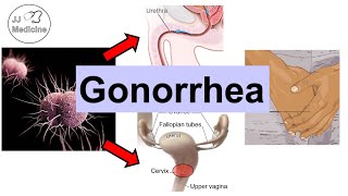 Gonorrhea Neisseria Gonorrhea  Pathophysiology Symptoms amp Complications Diagnosis Treatment [upl. by Eidob892]