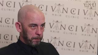 Vinci Hair Clinic Manchester MSP testimonial [upl. by Eriam]