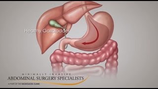 Gallbladder Symptoms [upl. by Bonney]