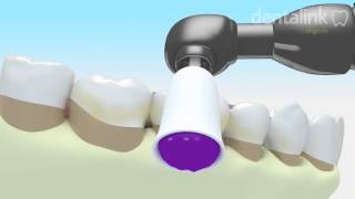 LIMPIEZA periodontal supragingival Sarro dental  Video 3D [upl. by Soulier843]