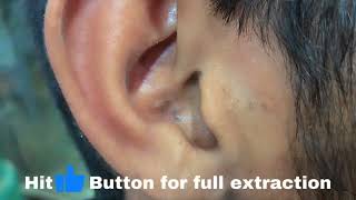 Intense Blackheads Behind The Ears  Blackheads Removal Pimple Popper [upl. by Murray]