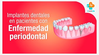 Implantes dentales en pacientes con enfermedad periodontal  Tu Salud Guía [upl. by Fawcette]