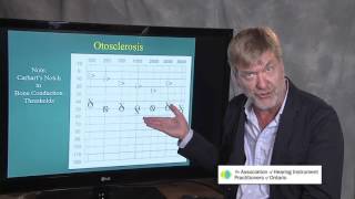 Ted Venema Talks Otosclerosis [upl. by Samal]