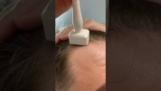 Derma Stamping And Using Minoxidil For Hair Growth [upl. by Malamud]