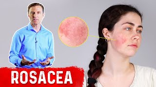 What Can Be Done for Rosacea [upl. by Onaivlis406]