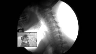 Video Fluoroscopy of my neck [upl. by Nahem]