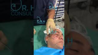 Subcision Treatment  Dr H Consult [upl. by Eerb]