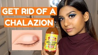 HOW TO GET RID OF A CHALAZION FAST AT HOME [upl. by Klement489]