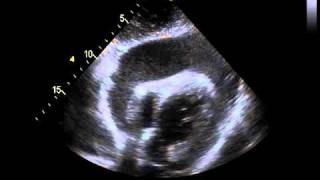 Echocardiography with a Significant Pericardial Effusion [upl. by Held]