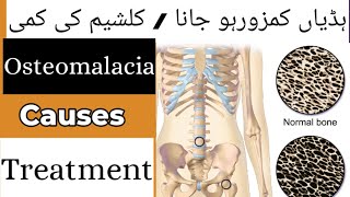 What is Osteomalacia  Rickets causes sign and symptoms Treatment medicine prevention In Hindi [upl. by Soll]