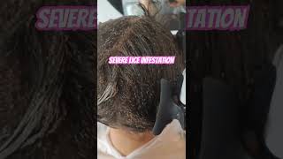 Lice Infestation l lice removal l small business explore hair lice hairvideo [upl. by Mozart]