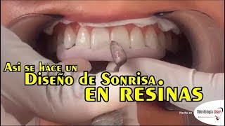 Asi se hace un Diseño de Sonrisa en resinas  Odontología Láser DiseñoDeSonrisa [upl. by Ahseikram]