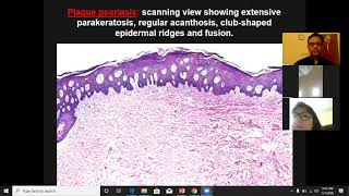 Lecture 4 Dermatopathology Psoriasiform and Spongiotic dermatoses [upl. by Aerdnaid]