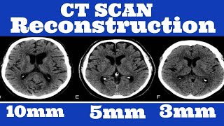 How to Do Ct Reconstruction [upl. by Eidnam]