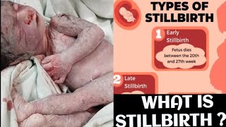 What is Stillbirth and its Classification dranshumantripathi3599 [upl. by Baniaz]