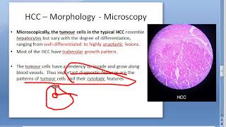 Pathology 635 a Hepato Cellular carcinoma Hepatocellular liver malignant hepatoma HCC cause [upl. by Sheryle]