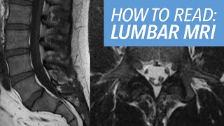 How I Read an MRI of the Lumbar Spine Sequences Search Pattern and Example Cases Explained [upl. by Siradal]