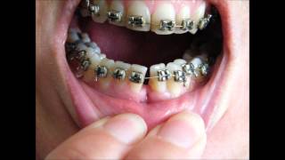 Bracesretainersbrackets  before and after timelapse 36 yr old [upl. by Atilrak133]