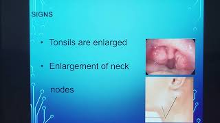 Chronic tonsillitis  To operate or not   English  Patient teaching programme [upl. by Aileduab572]