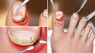 ASMR Remove ingrown toenails toenail clipping toenail swelling and clean up pedicure [upl. by Rosenquist]