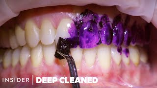 What To Expect From a DEEP Cleaning at the Dentist [upl. by Alfredo]