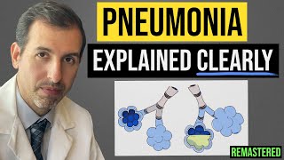 Pneumonia Explained Symptoms Diagnosis Labs Treatment [upl. by Koblas]