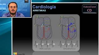 Curso CT cardiologia  8 Arritmias [upl. by Llehctim]