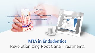 ROLE OF MTA IN ENDODONTICS dental dentalkart waldentMTA EndolifeMTA [upl. by Eppie]