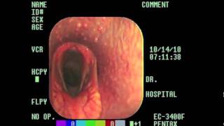 Laryngeal Hemiplegia Explained m4v [upl. by Hennie]