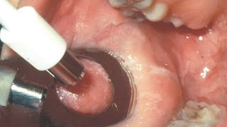 Biopsia de la mucosa bucal T26 [upl. by Lorrad]