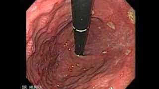 Endoscopy of Multiple Ulcers of the Stomach [upl. by Rezeile765]