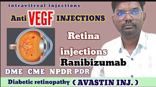 Anti vegf injections  avastin injections  Ranibizumab injections  Bevacizumab injections  vegf [upl. by Bertie353]