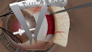 Strabismus surgery Resection [upl. by Nnyltak]