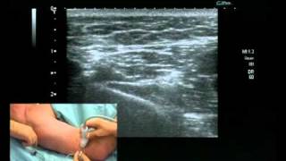 Radial Nerve Block ultrsound guided [upl. by Richard]