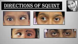 Different Directions of Ocular Deviation  Esotropia Exotropia Hypertropia Hypotropia  Squint [upl. by Atsedom]