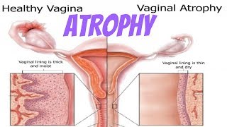 Atrophy  Physiology amp Pathology  Explained [upl. by Ahsimit862]