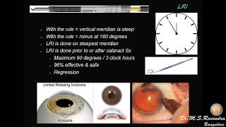 Modern Cataract Surgery Alcon ReSTOR IOL with LRI [upl. by Ailasor]