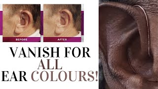 The Solution for Every Ear Colour Vanish Hide my Hearing Aid Review [upl. by Lockwood260]