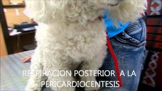 PERICARDIOCENTESIS  CITOLOGIA CON CELULAS NEOPLASICAS [upl. by Modestine]