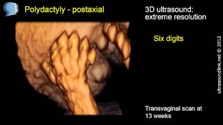 Polydactyly 3D ultrasound amazing resolution [upl. by Zales]