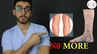 ما هى دوالى الساقين ؟  علاج مشكلة الدوالى نهائيا varicose veins treatment [upl. by Akinak]