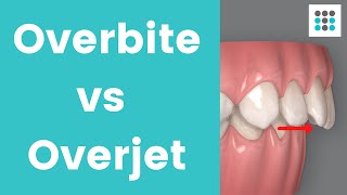 OVERBITE VS OVERJET l Dr Melissa Bailey Orthodontist [upl. by Ednarb]