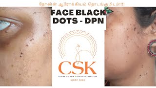 DPN face black dots face black dots face black mole dpn skin problem tamil dpn best medicinedpn [upl. by Oneill]