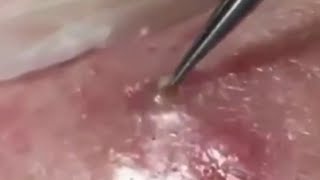 Deep BLACKHEAD Removal on Cheeks  Cystic Acne Treatment [upl. by Onurb846]