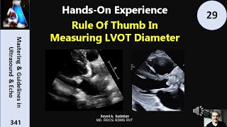 HandsOn Experience 29 Rule Of Thumb In Measuring LVOT Diameter [upl. by Nyleaj799]